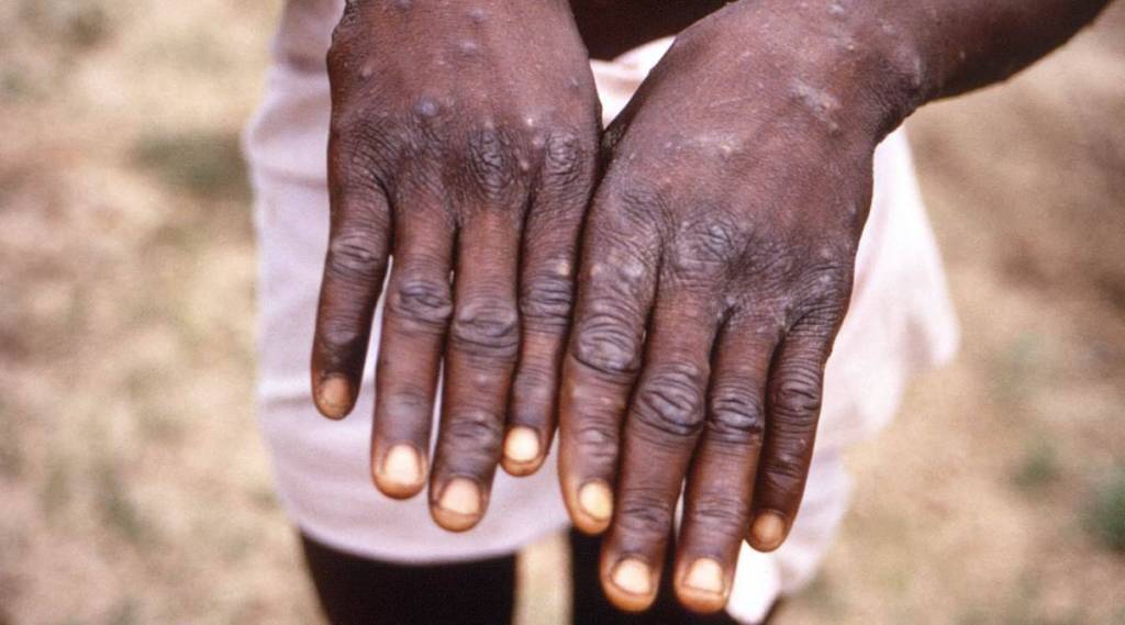monkeypox news