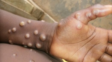 In the United States, 99.1% of U.S. monkeypox cases occurred among those assigned the male sex at birth as of July 25, according to a technical report by the U.S. Centers for Disease Control and Prevention (CDC). Among male patients, 99% reported having sexual contact with other men.