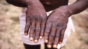 "We are thinking of conducting a sero-survey among close contacts of monkeypox-affected people in India to check for the presence of antibodies in them.
