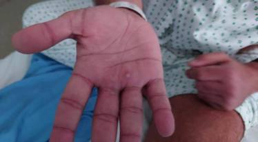 monkeypox symptoms