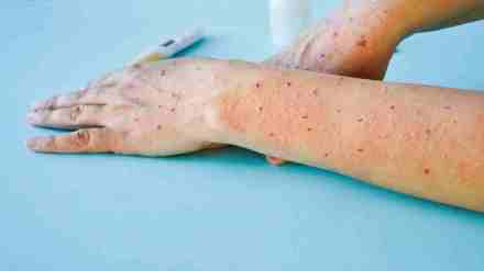 India's first tomato flu case was reported in Kerala's Kollam district on May 6. India's first tomato flu case was reported in Kerala's Kollam district on May 6.