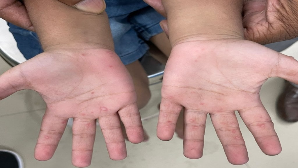 Tomato Flu in India | The 'New Virus' Tomato Flu |