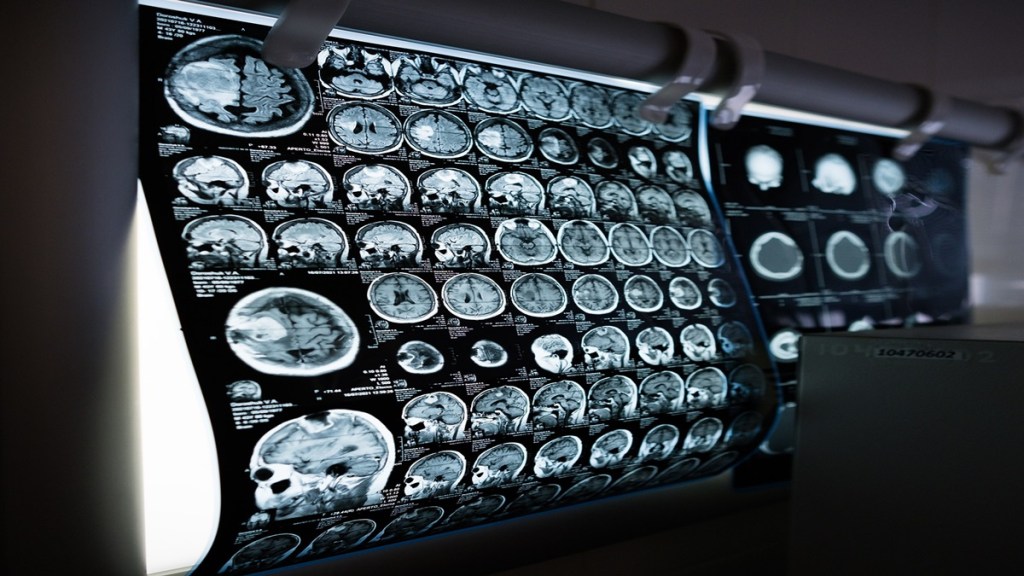 GlobalData, Alzheimer's Disease, Leqembi, Eisai, Biogen, Healthcare news, pharma news,