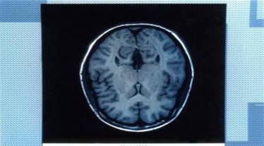 Stroke, Migraine, tremors, neurological disorder, health news, healthcare news,