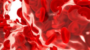 Sickle-Cell Anaemia, Anaemia, Diagnostics tests, healthcare news, diagnostics news,