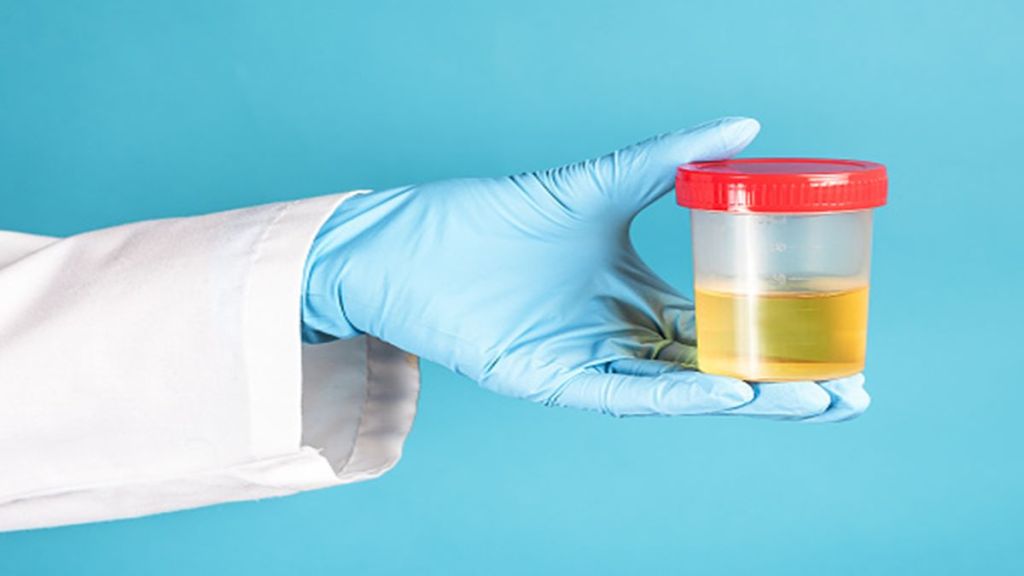 Urine sample, Urine test, urine colour, healthcare news, health news,