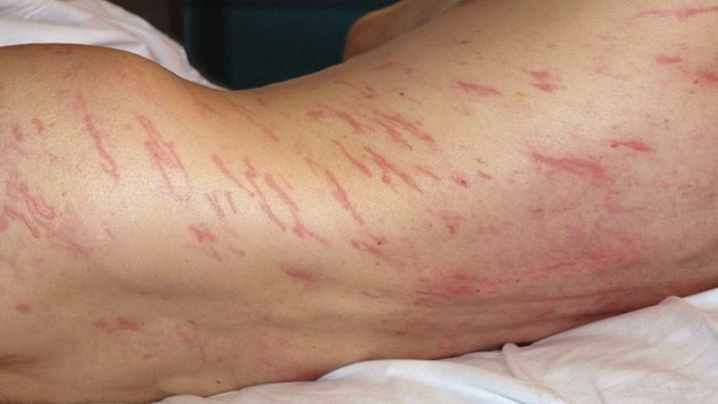 Roundworm, Roundworm infection, roundworm infection, spanish man, healthcare news,