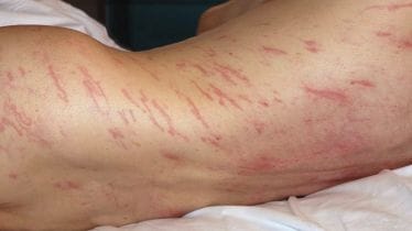 Roundworm, Roundworm infection, roundworm infection, spanish man, healthcare news,