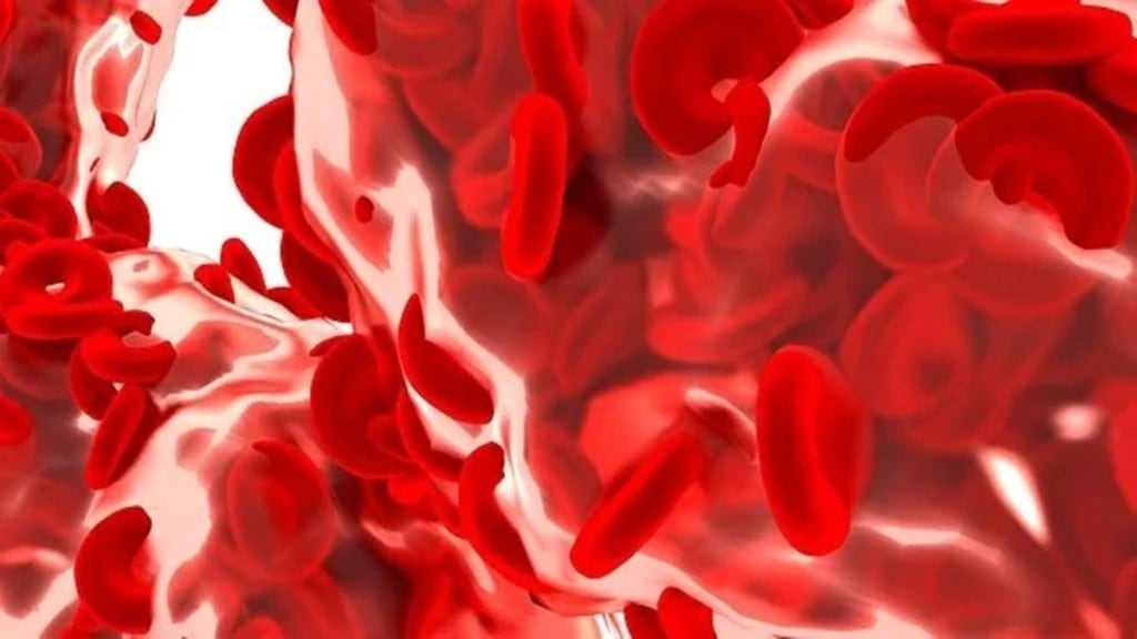 Sickle cell anaemia