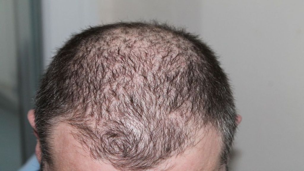 baldness, male baldness, hair loss, hair loss treatment, health news,