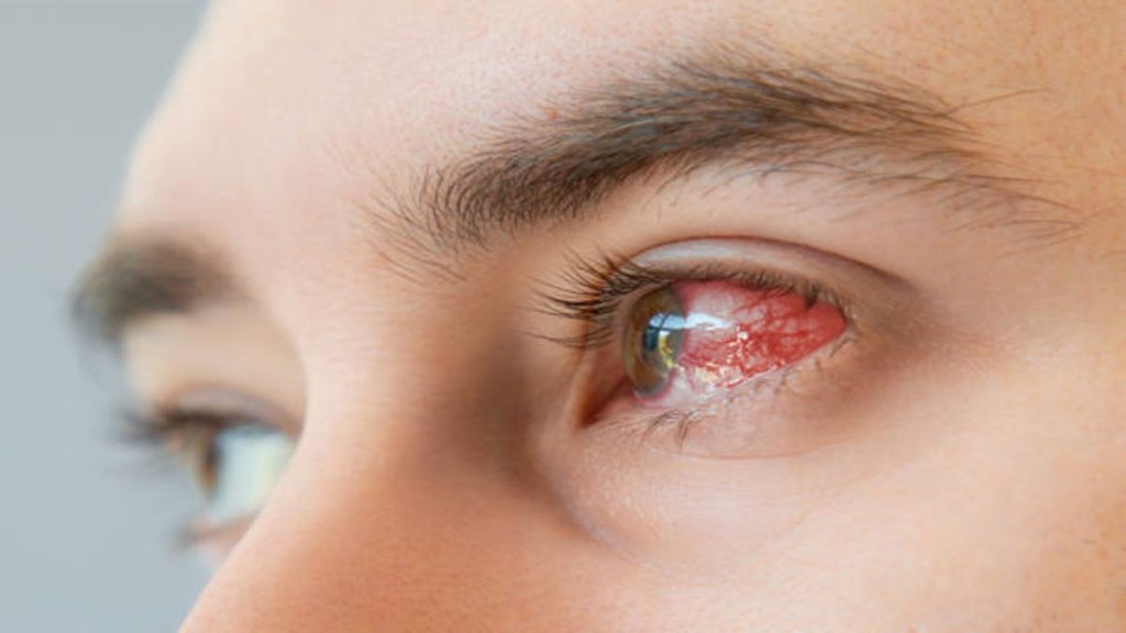 Eye flu, eye flu cases in India, eye flu symptoms, eye flu treatment, healthcare news,