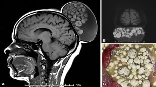 Rare medical cases, brain tumour, cysts, sack of marbles, healthcare news,