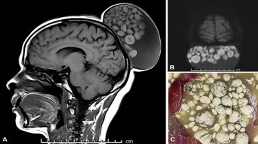 Rare medical cases, brain tumour, cysts, sack of marbles, healthcare news,
