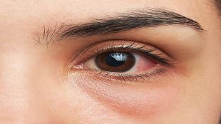Eye flu, eye flu in india, eye flu in delhi ncr, conjunctivitis, conjunctivitis treatment, conjunctivitis symptoms, healthcare news,
