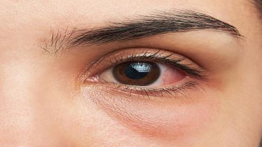 Eye flu, eye flu in india, eye flu in delhi ncr, conjunctivitis, conjunctivitis treatment, conjunctivitis symptoms, healthcare news,