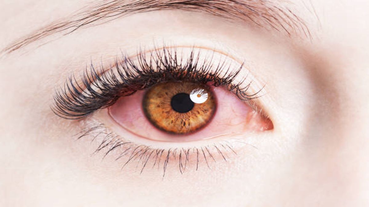 Conjunctivitis, conjunctivitis in India, eye flu, eye flu in india, conjunctivitis symptoms, healthcare news, Conjunctivitis, conjunctivitis in India, eye flu, eye flu in india, conjunctivitis symptoms, healthcare news,