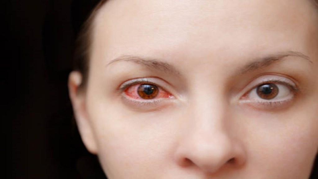 Conjunctivitis, conjunctivitis cases, conjunctivitis in india, eye flu symptoms, eye flu treatment, healthcare news,
