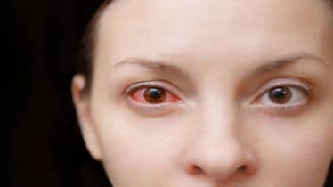 Conjunctivitis, conjunctivitis cases, conjunctivitis in india, eye flu symptoms, eye flu treatment, healthcare news,