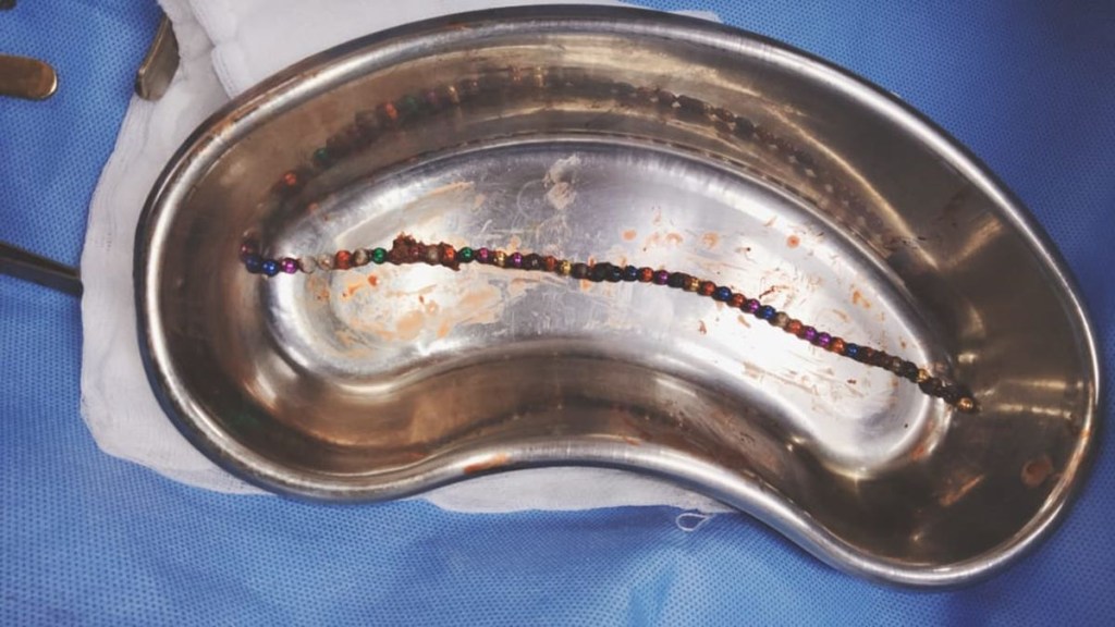 Abdomen pain, magnets, toys, bizarre medical cases, surgery, healthcare news,
