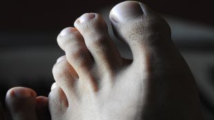 Diabetes, heart diseases, feet symptoms, feet diseases, health news, wellness news,