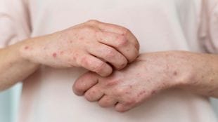 Atopic Dermatitis, Atopic Dermatitis symptoms, Atopic Dermatitis treatment, Sanofi, healthcare news, pharma news,