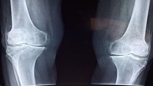 orthopedics, 3d revolution, healthcare news, medical devices,