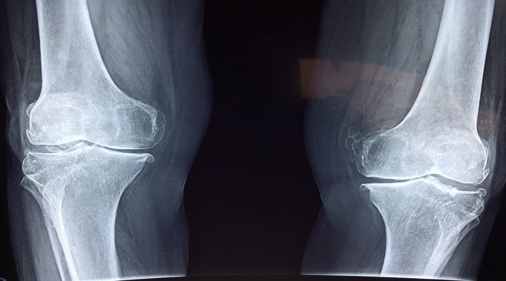 orthopedics, 3d revolution, healthcare news, medical devices,