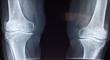 orthopedics, 3d revolution, healthcare news, medical devices,