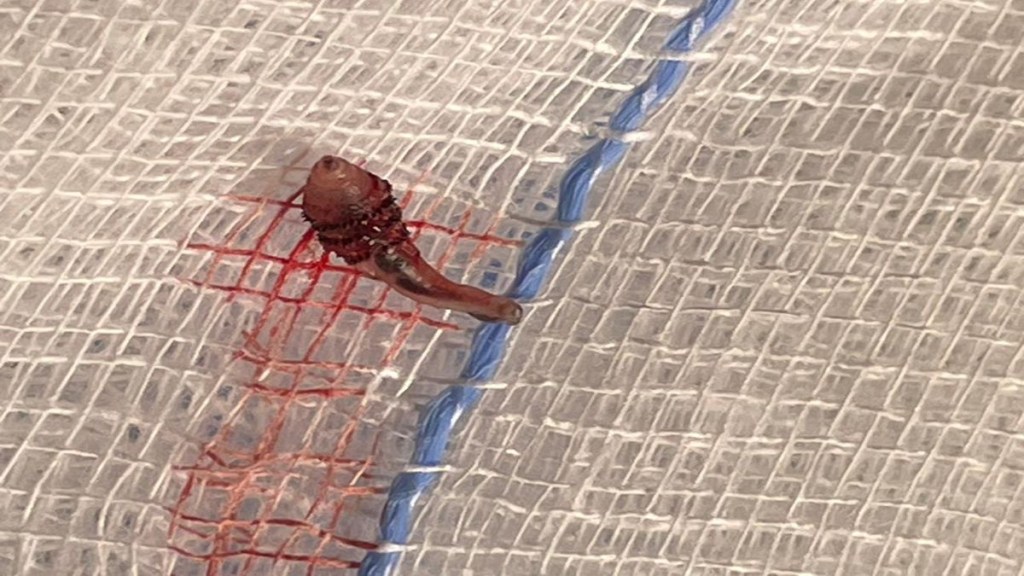 live botfly larva, live botfly, Bizarre medical case, rare medical case, healthcare news,