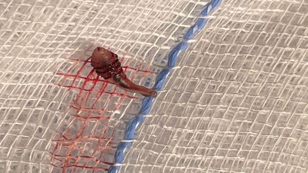 live botfly larva, live botfly, Bizarre medical case, rare medical case, healthcare news,