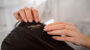 Dandruff, Dandruff cure, dandruff treatment, dandruff symptoms, healthcare news, wellness news,
