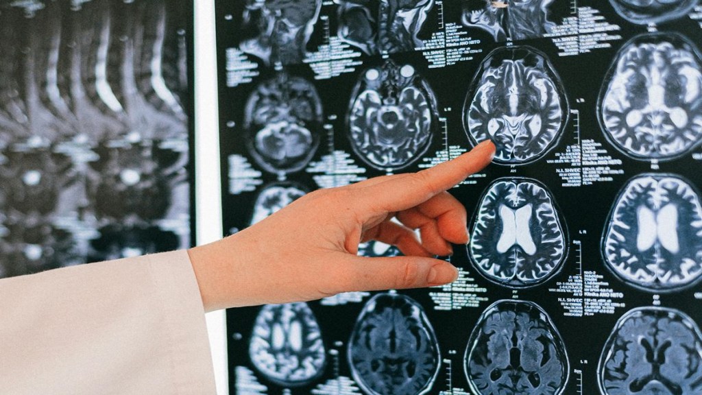 COVID-19, COVID-19 infection, covid variant, brain effect, healthcare news, covid news,