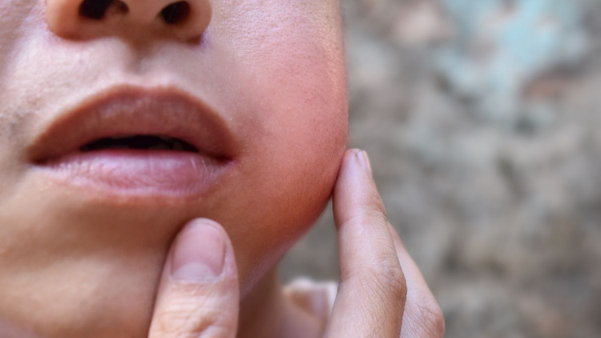 mumps, himachal pradesh, hamirpur, mumps infection