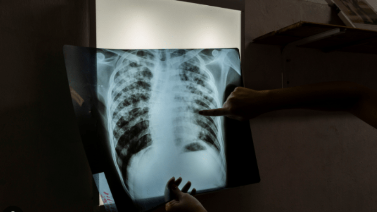 Tuberclosis Tuberclosis