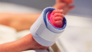 New Born Hearing Screening: Fundamental Right Issue