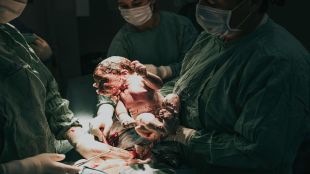 Women four times more likely to have C-sections in private hospitals of India; Sharp uptick reported in C-section deliveries between 2016 and 2021