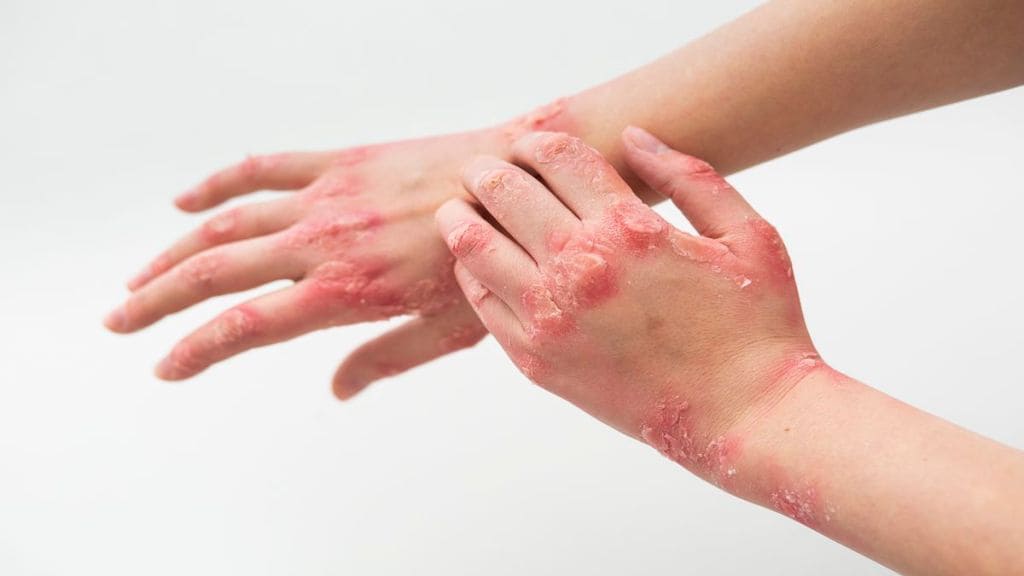 Eczema, Eczema symptoms, skin diseases, salt intake, high salt intake, health news, wellness news,
