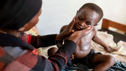 Mpox Symptoms and Causes, Monkeypox Virus: