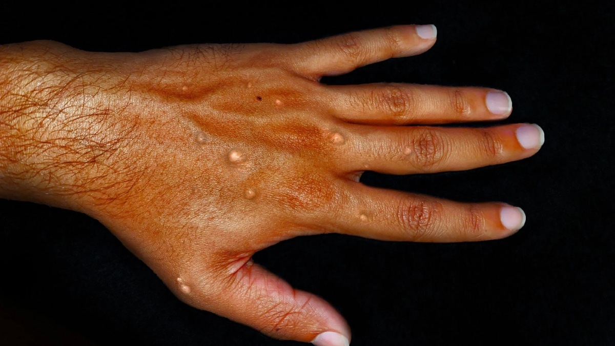 Explainer: Why mpox outbreak is a global emergency