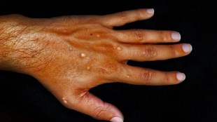 Explainer: Why mpox outbreak is a global emergency