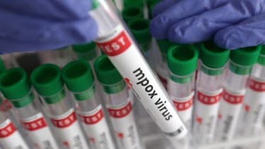 Mpox, Singapore mpox, mpox news, india mpox, mpox cases, WHO mpox, Singapore flights, Singapore India, mpox variants, variants of Mpox, monkeypox, mpox virus, monkeypox in India, Singapore monkeypox