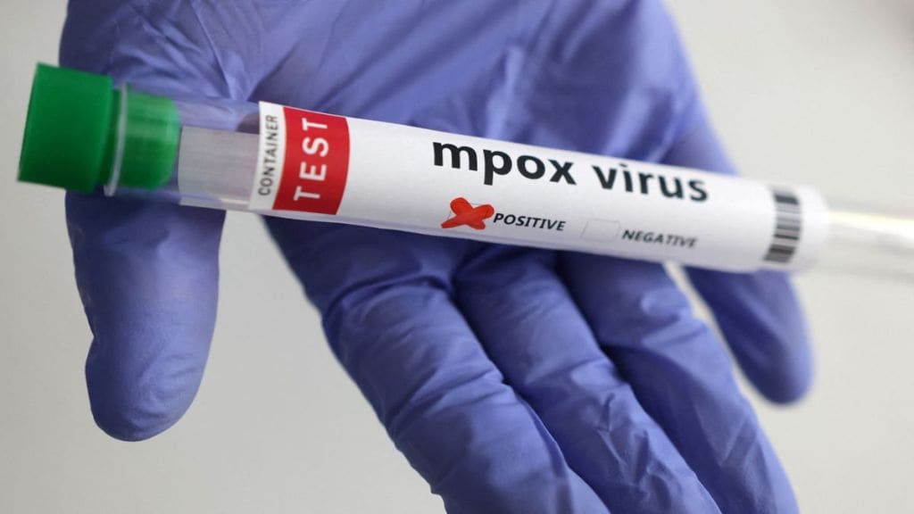 Mpox haryana, mpox haryana case, mpox in india, mpox symptoms, mpox treatment, mpox LNJP, health news, wellness news,