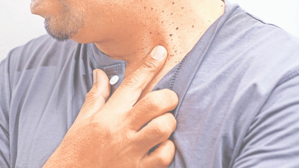 growths on skin