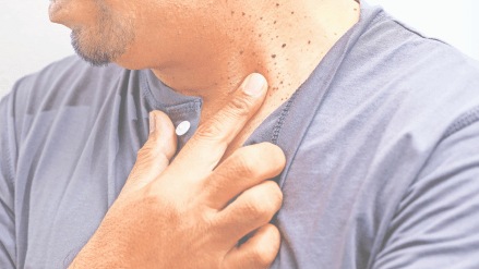 growths on skin