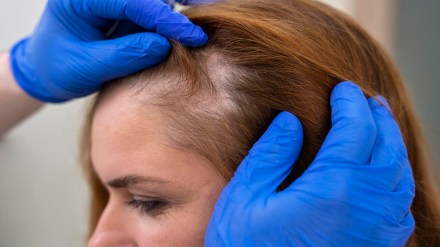 Hair fall, hair loss, alopecia, alopecia symptoms, alopecia treatment, hair loss treatments, health news, wellness news,