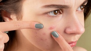 Adult acne, adult acne symptoms, adults acne symptoms, adult acne treatment, health news, wellness news,