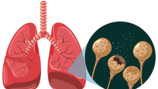 tuberculosis