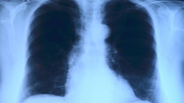 India develops indigenous hand-held X-ray for TB screening