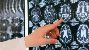 Diagnosed prevalent cases of Parkinson’s disease to reach 3.15 million in seven major markets by 2033
