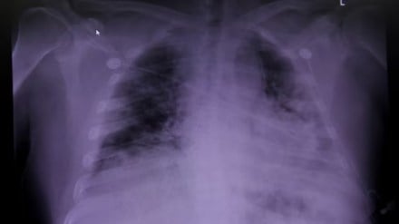 Idiopathic Pulmonary Fibrosis Causes, Idiopathic Pulmonary Fibrosis Symptoms